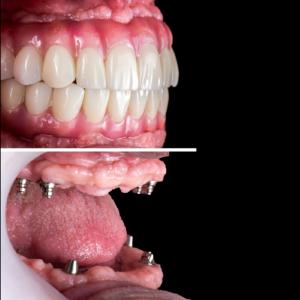 Phục hình Implant